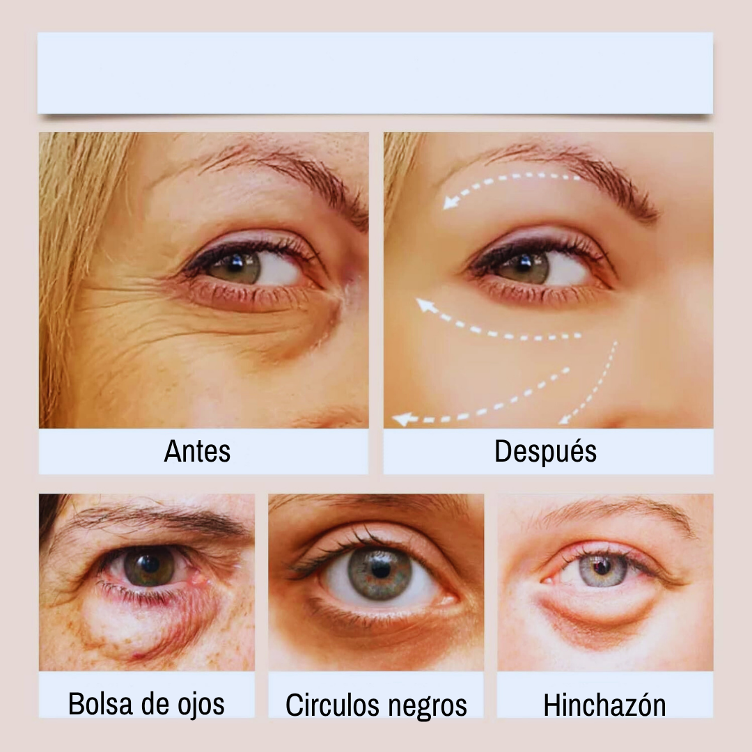 Crema Para Ojos De Papa Reduce La Hinchazón Y Las Ojeras