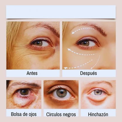 Crema Para Ojos De Papa Reduce La Hinchazón Y Las Ojeras